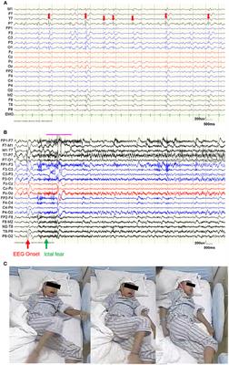 Occipital Lobe Epilepsy With Ictal Fear: Evidence From a Stereo-Electroencephalography (sEEG) Case